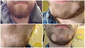 Facial hair loss in males in multiple spots is termed allopecia barbae and is very similar to allopecia areata. Why Are There Now White Spots In My Beard I Made A Trimming Mistake And So I Shaved It Off A Few Days Later And It S Growing Back Normally But With Two