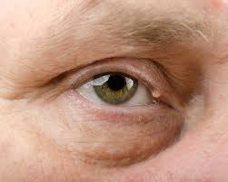 Image result for milium cyst on eyelid