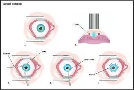 Pin On Ophthalmology Eyes
