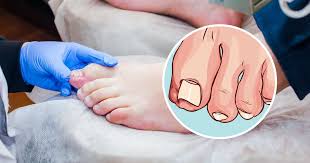 Check spelling or type a new query. Cara Merawat Kaki Cagu Kuku Cekam Ibu Jari Kaki Bengkak Dan Sakit
