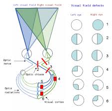 Image result for Visual Field Deficit
