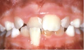 Maybe you would like to learn more about one of these? Problems To Look For At Age 7 8 Anterior Crossbite Underbite