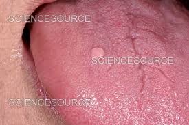 Image result for papillomavirus tongue)