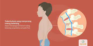 Penyakit tipes umumnya dikarenakan oleh kelelahan dan lingkungan yang kotor. Tuberkulosis Tulang Belakang Tanda Dan Gejala Penyebab Cara Mengobati Cara Mencegah
