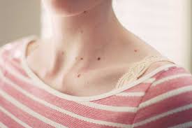 Tiny red spots on your skin can appear anywhere on your body. 13 Photos Of Skin Spots And What Caused Them Alton Telegraph