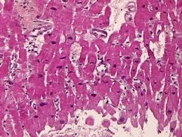 Myocarditis can be classified in a number of different ways. Histopathology Of Myocarditis Sciencedirect