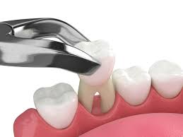 Image result for Tooth Extraction