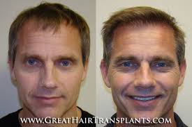 Low-cost Hair Transplant in Alabama Randolph Cedron