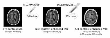 Gadolinium is not directly seen in an mr image, but manifests its presence indirectly by facilitating the relaxation of nearby hydrogen protons. Artificial Intelligence May Help Reduce Gadolinium Dose In Mri Eurekalert Science News