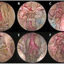 Endonasal Part. Intradural Work.