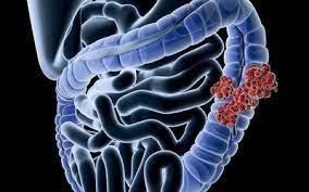 A number of patients with colon cancer have been misdiagnosed with inflammatory bowel diseases (ibd) such as irritable bowel syndrome, diverticulitis, and colitis. Colon Cancer In Women Signs Symptoms And Complications