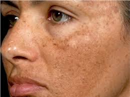 Existen tres tipos distintos de melasma Que Es El Melasma Y Que Causa Su Aparicion Equilibrio Y Belleza Asesora De Belleza Y Tienda Online
