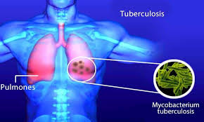 Resultado de imagen de bacteria tuberculosis
