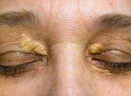 Image result for xantelasma