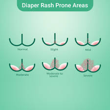 Image result for diaper dermatitis adult -children -infant -baby