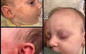 My 8 Week Old Started Out With Baby Acne And It Turned Into Heat Rash With Blisters It Got So Bad That Her Poor Eyes Were Swo Baby Acne Baby Eczema