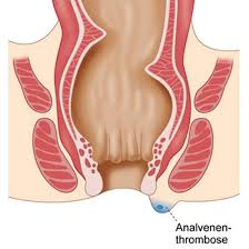 Haemorriden.net » expertenrat hämorrhoiden | expertenfrage. Hamorrhoiden Arzt Wien Moderne Hamorrhoidenbehandlung Spezialist