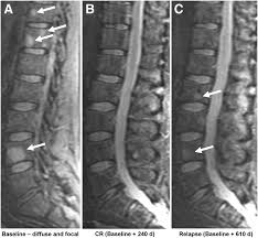 Multiple myeloma is a type of cancer of the blood that is formed in the bone marrow. Imaging Of Multiple Myeloma And Related Plasma Cell Dyscrasias Journal Of Nuclear Medicine