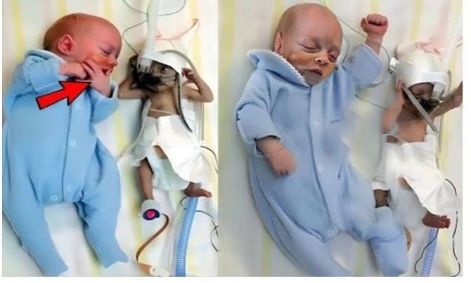 Mom Gives Birth to Twins Then Doctors Realize One of Them Isn't a Baby | by Tee_thewriter | Medium