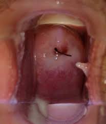 Do you have milky white vaginal discharge and want to know what's up? Vaginal Discharge Wikipedia