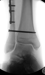 After a fracture, there's about a 10 percent chance that you may develop some degree of arthritis in the ankle over the. Ankle Fracture Wikidoc