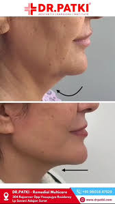 Dr. Amol Rathore Returns to Aesthetics by Shikha Sardana for Botox,  Fillers, and Threads