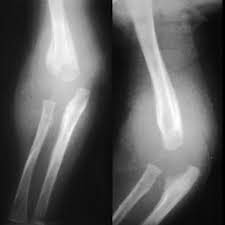 Image result for Osteomyelitis XRay