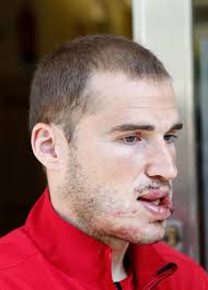 Polideportivo: Álex bergantiños recibió 70 punto de sutura en...