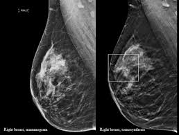 Breast cancer and some noncancerous (benign) breast conditions can appear white on a mammogram. More Breast Cancers Detected With 3d Mammography National Breast Cancer Foundation Nbcf Donate Online