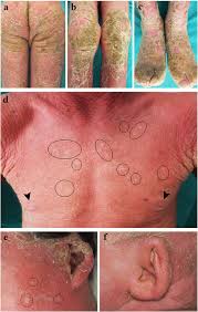 Image result for Ichthyosis