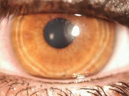 Wie Kommen Die Ringe In Die Iris Augen Optik