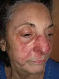 Maybe you would like to learn more about one of these? What Is Lupus Pernio Quora