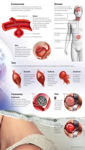 Explicamos sus causas, síntomas, tratamiento y pronóstico. Aneurisma Cerebral Es Mortal Como Hacer Sogas De Cuero De Vaca
