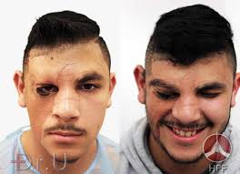 Facial hair transplantation is a suitable option for the patients who have lost their facial hair or who are facing hair thinning problem. Dr U Reconstructs Teen S Eyebrow And Beard With Leg Hair Helping Him Embark On A New Life Chapter Dr U Hair Skin Clinic Fue Hair Restoration Dermatology And Laser Surgery