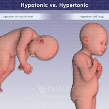 Image result for Floppy Infant