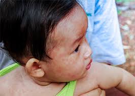 Image result for measles