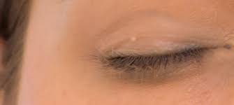 Keratosis pilaris is a minor condition that causes small bumps, much like goose bumps, on the skin. The Difference Between Keratosis Pilaris And Milia Viabuff