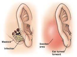 Tinnitus There S A Ringing In My Ears In 2021 Ear Infection Remedy Ear Infection Ear