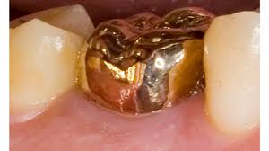 Average cost of a filling without insurance. Gold Crown Tooth Cost And Comparison To Porcelain