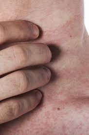 Image result for Skin Infection
