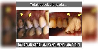 Sejatinya, gigi bungsu merupakan empat molar (gigi geraham) posterior. Iqbal Rosali On Twitter 4 Tidak Gosok Gigi Pada Bahagian Gigi Geraham Yang Menghadap Pipi Kawasan Ini Selalu Orang Tak Gosok Sebab Susah Nak Masukkan Berus Gigi Karang Gigi Senang Terbentuk Di