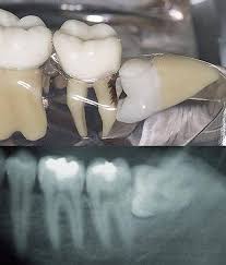 We did not find results for: Indication For Tooth Extraction