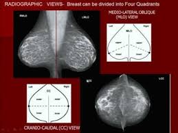 Code the primary site to c509 when there are multiple tumors (two or more) in at least two quadrants of the breast. Pin On Bca