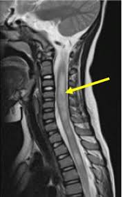 Image result for Myelitis