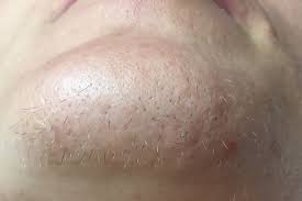 Excess hair refers to unwanted body and facial hair. Excess Hair Treatments Wimbledon Kensington