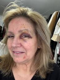 I simply fell over at the rescue and for some reason didn't let go of the… 