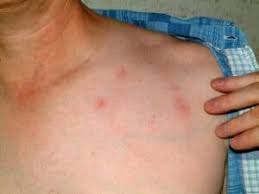 Image result for mite bites on humans