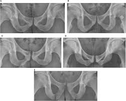 Image result for Pubic Apophysitis