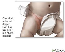 Image result for diaper dermatitis