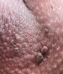 Image result for genital warts